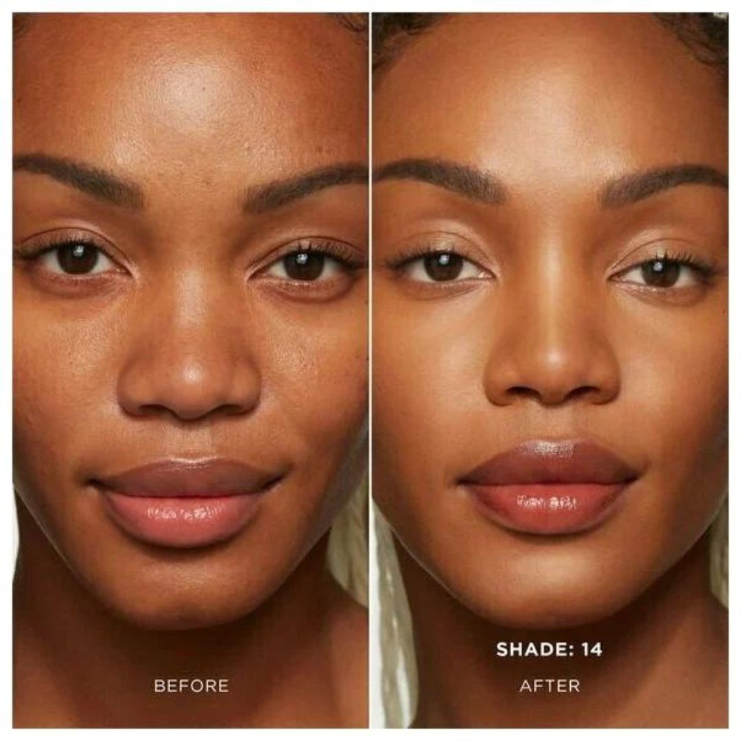 Stretch marks treatment