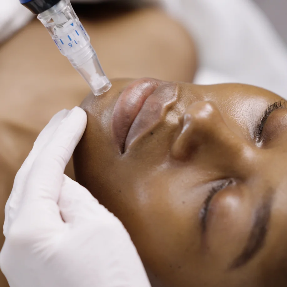 Microneedling